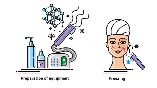 cryotherapy facial